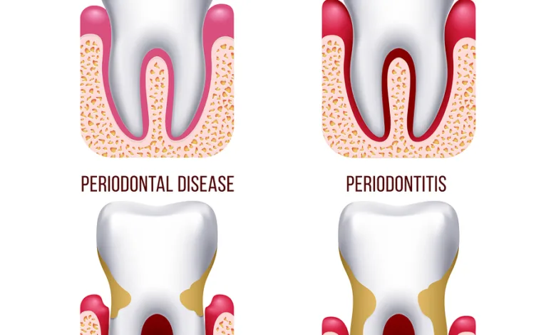 periodontology and periodontal diseases