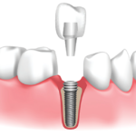 Dental Implants in the UK: