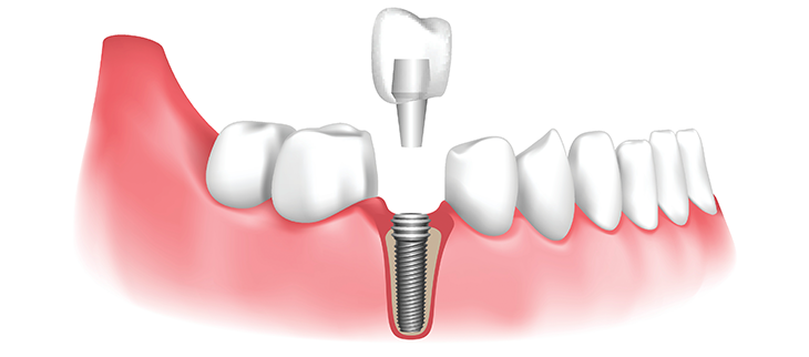 Dental Implants in the UK:
